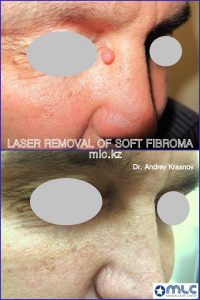 Лазерное лечение и удаления атером, фибром — доброкачественных опухолей кожи