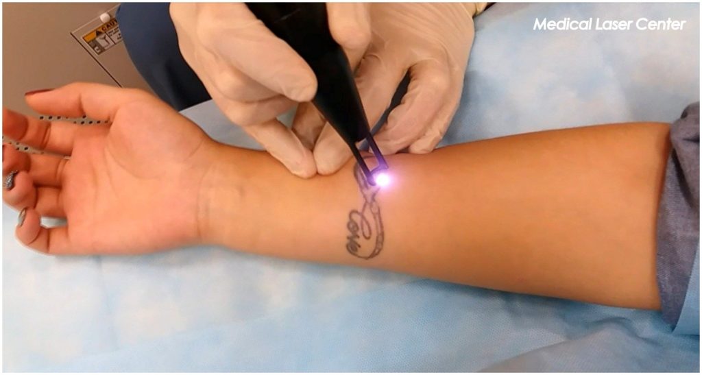 Лазерное удаление татуировки, SPECTRA: Lutronic, неодимовый лазер