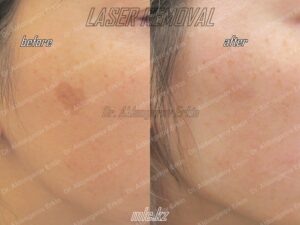 Лазерное удаление пигментных пятен (лечение мелазма, хлоазма, лентиго)