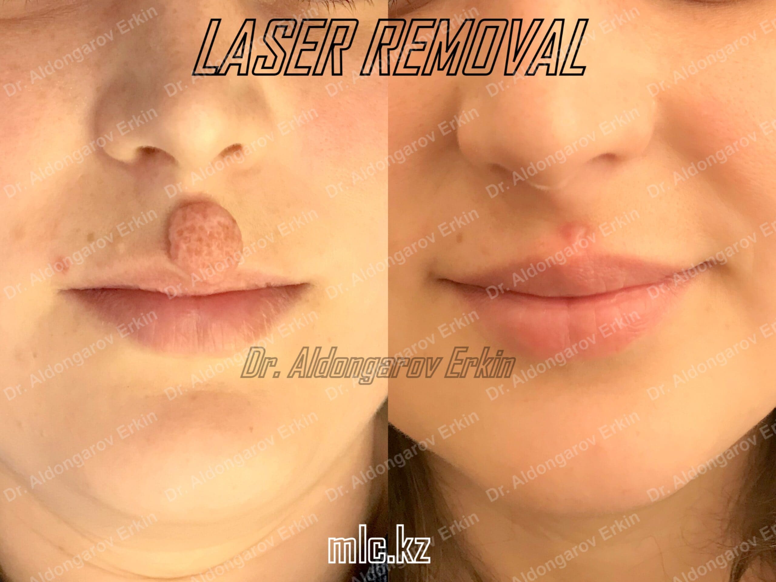 es-nevus-removal-1-scaled-1