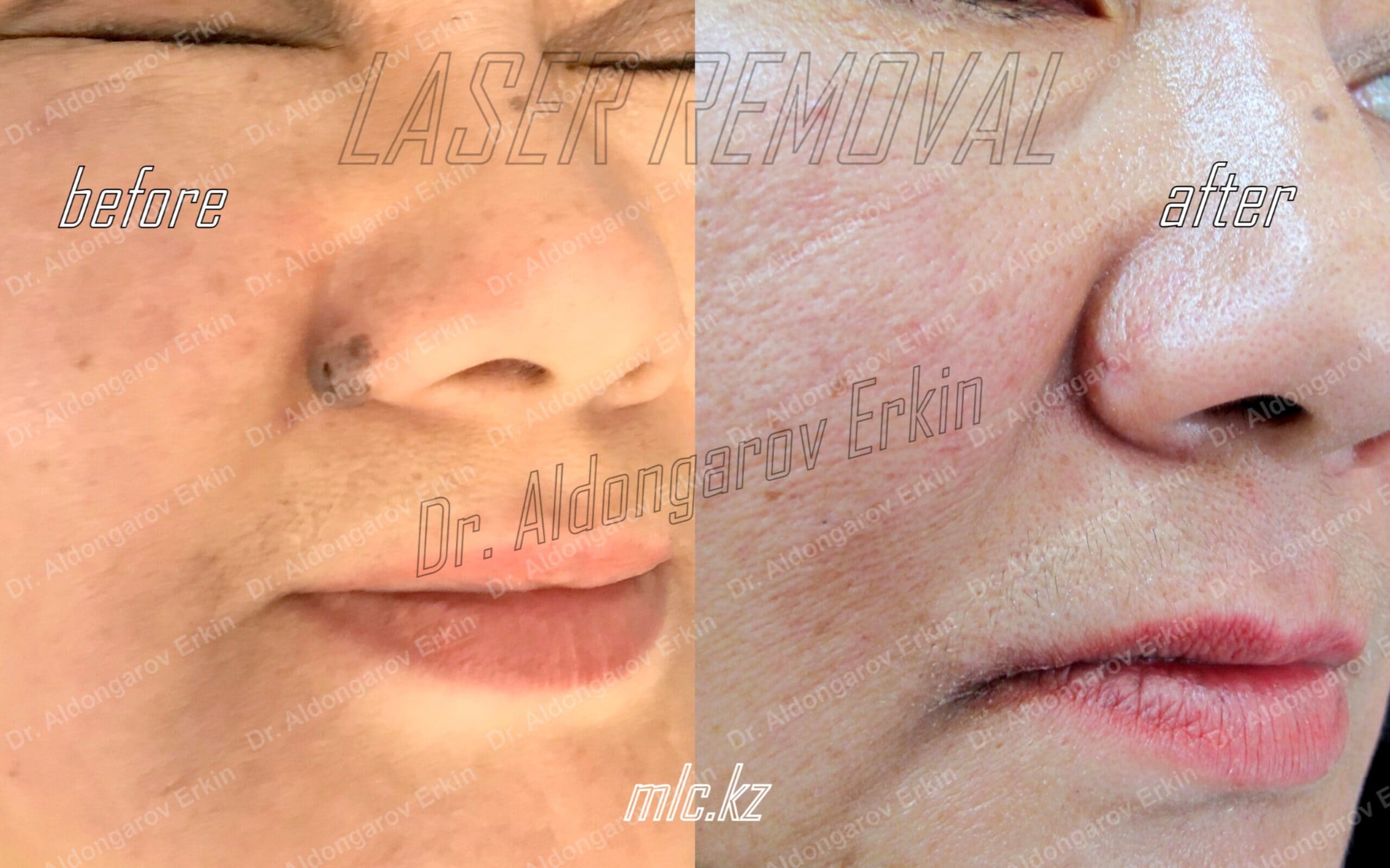 es-nevus-removal-2-scaled-1