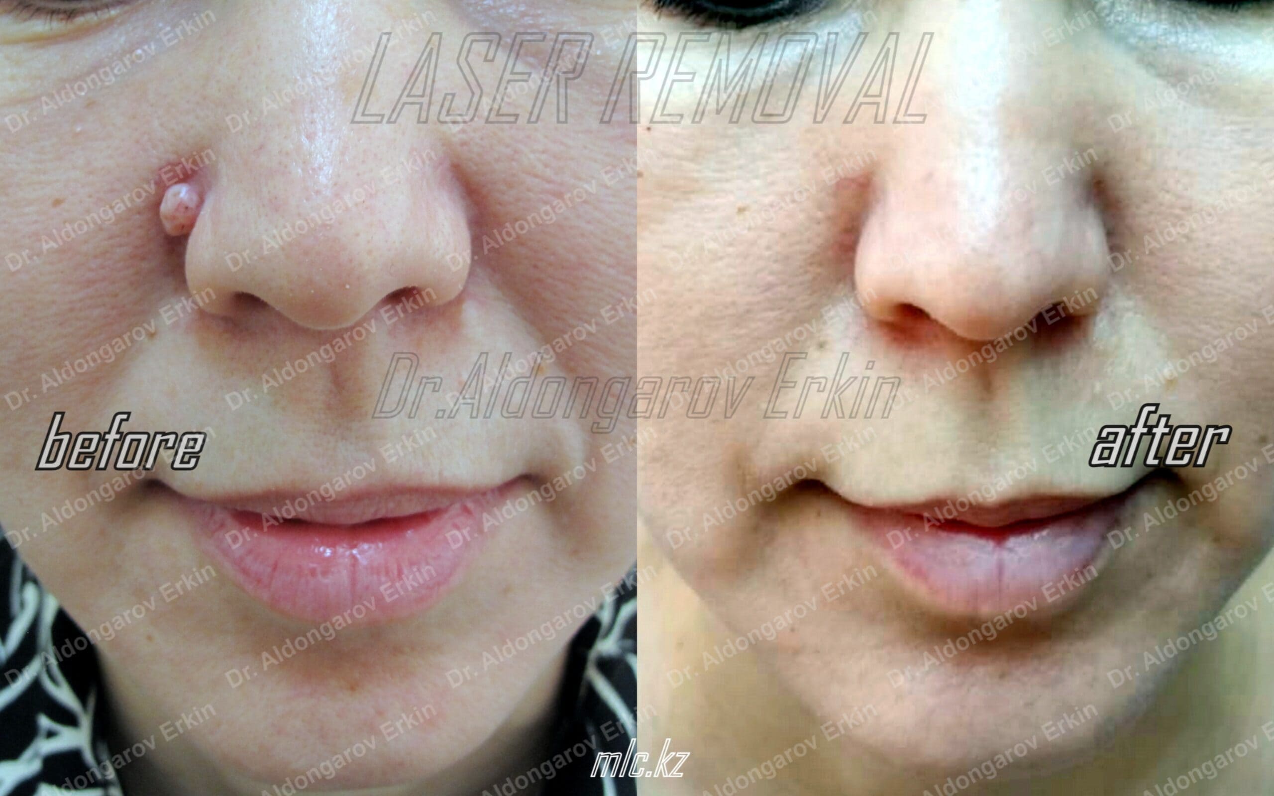 es-nevus-removal-3-1-scaled-1