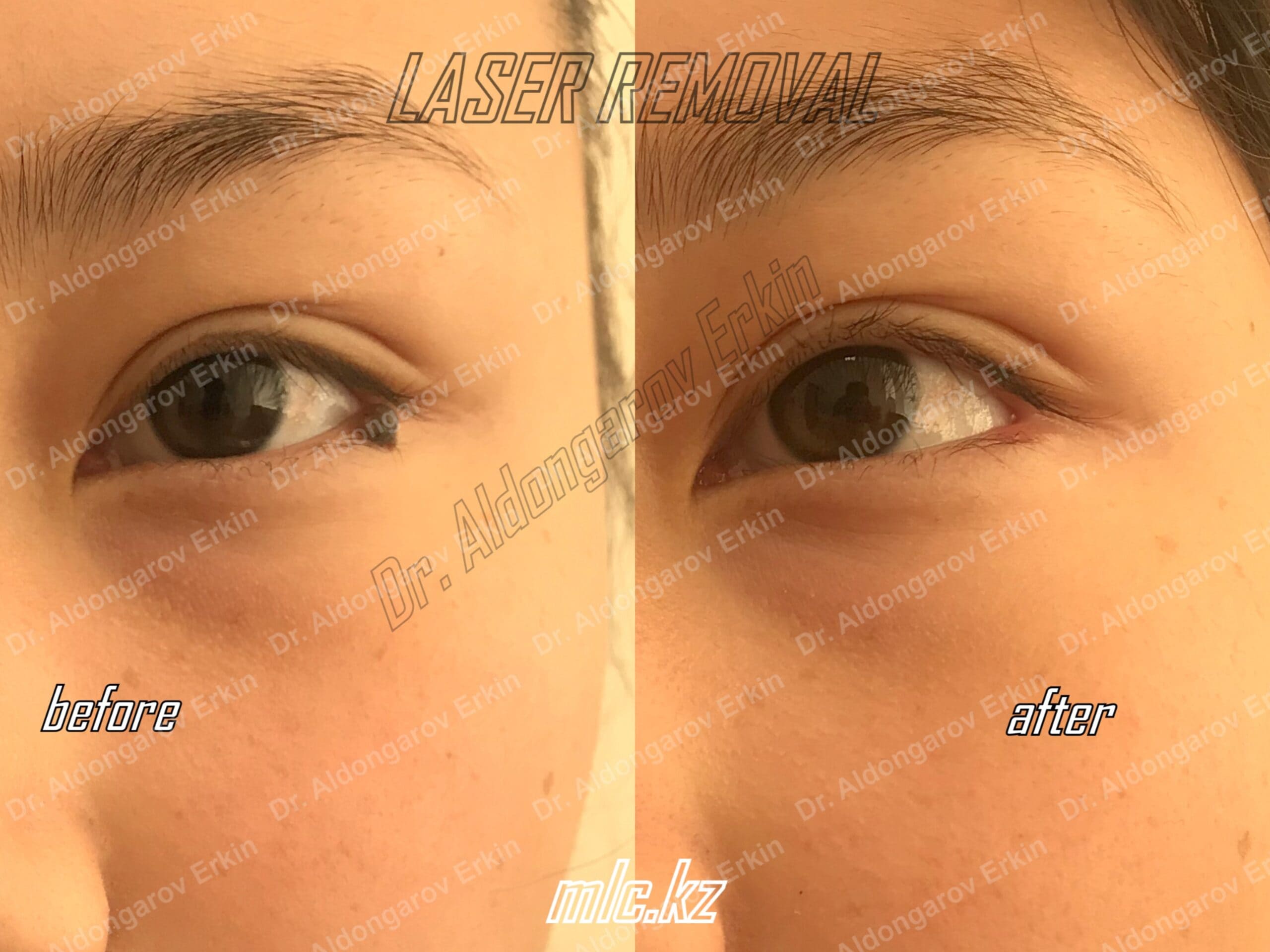 es-nevus-removal-4-scaled-1