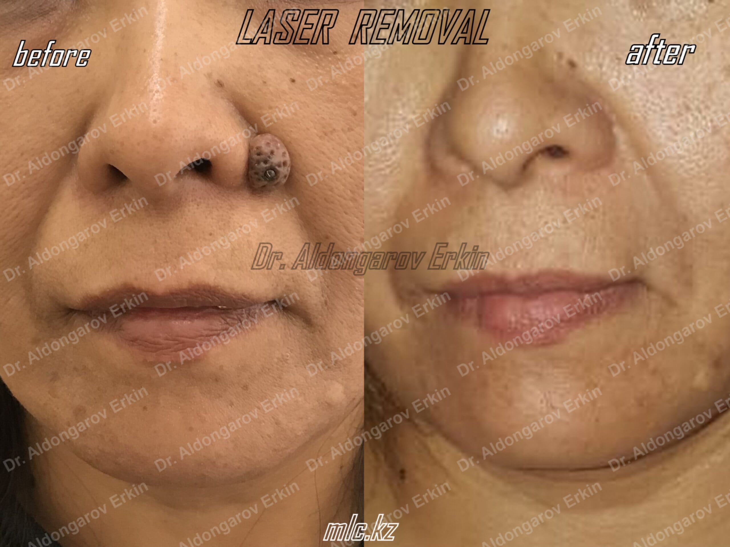 es-nevus-removal-6-scaled-1