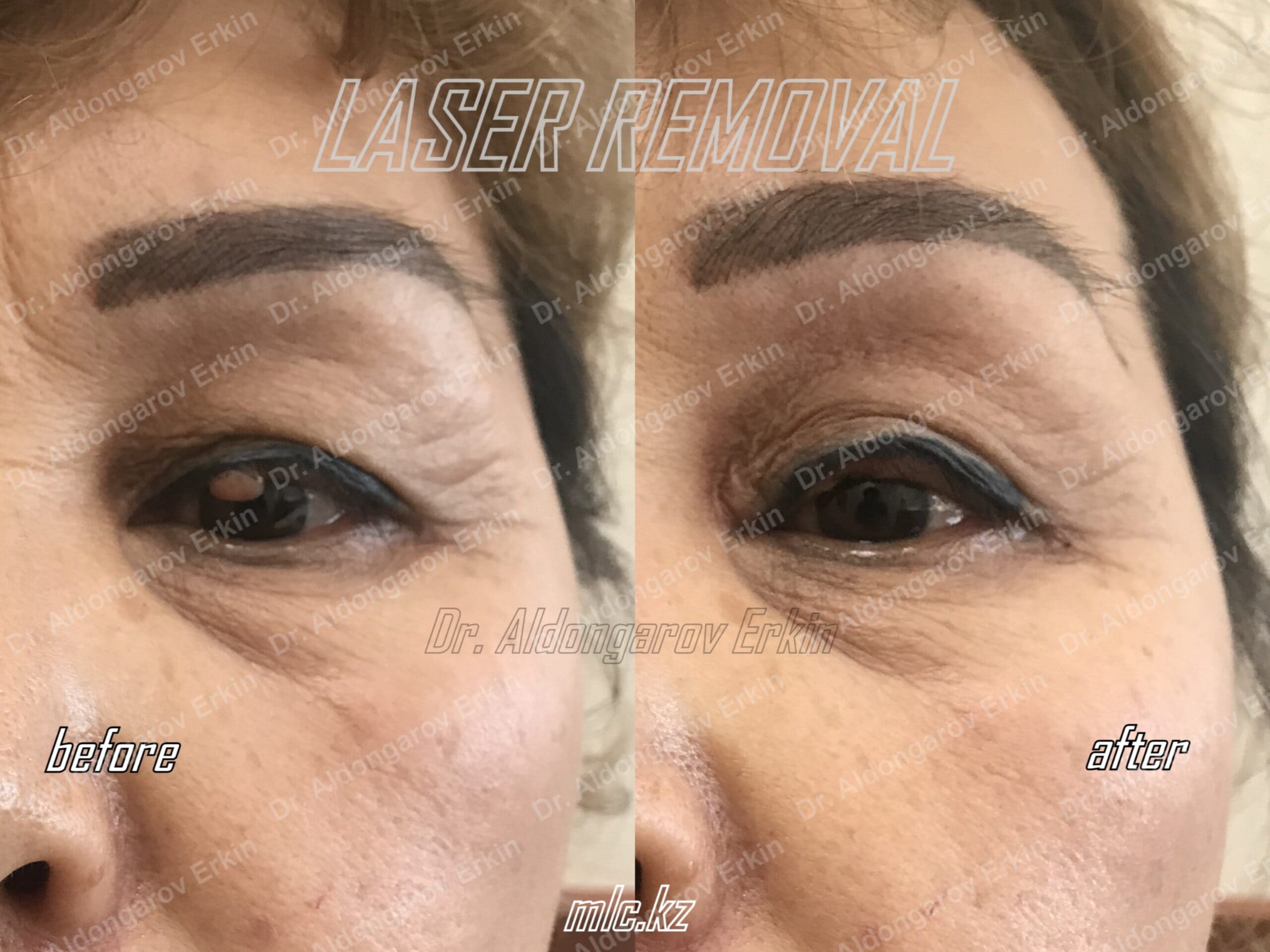 es-nevus-removal-7-scaled-1