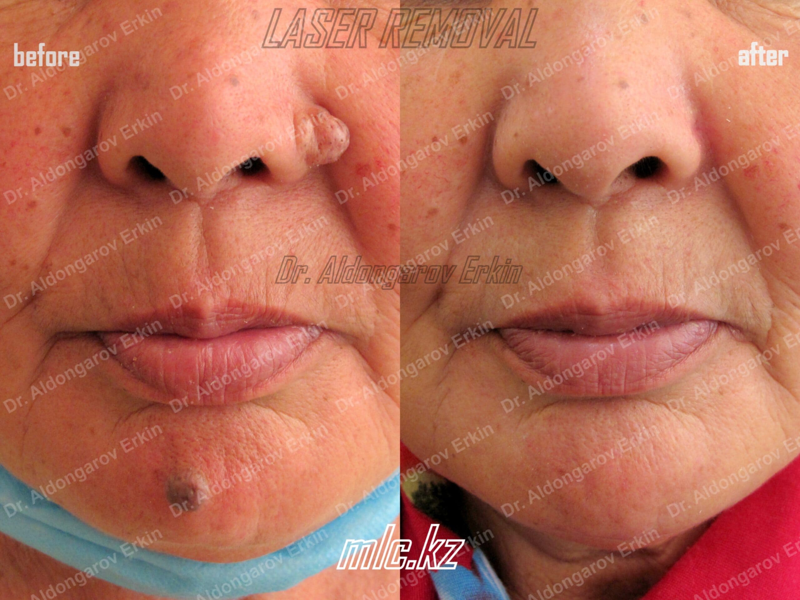 es-nevus-removal-8-scaled-1