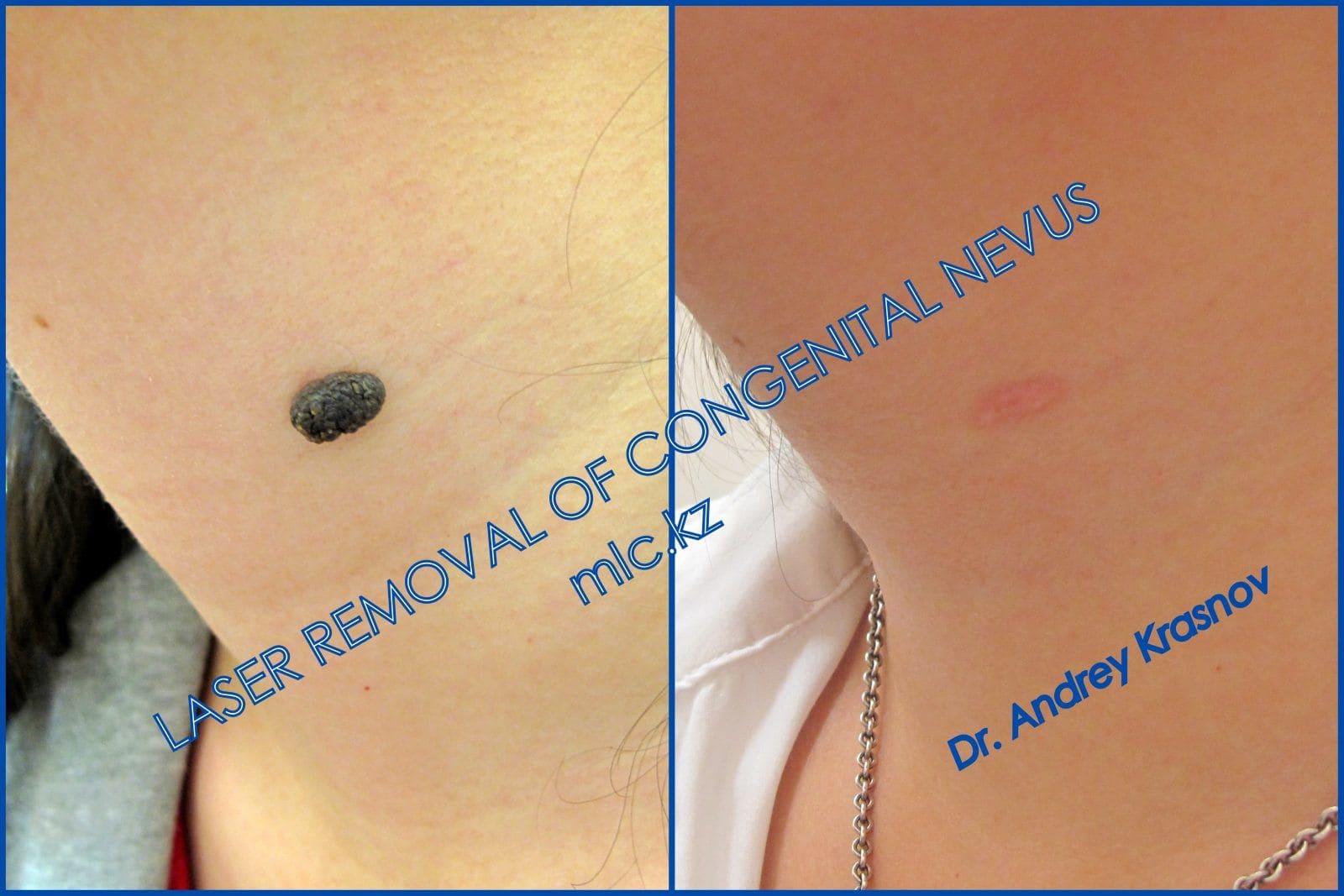 nevus-removal-3