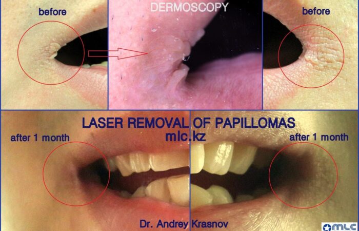 udalenie-papillom-2