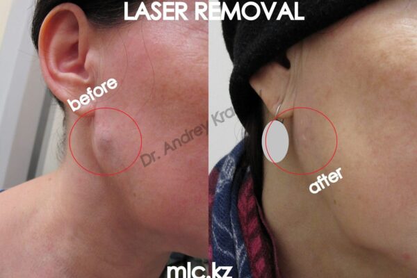 adenoma-18.10-1-2048x1448