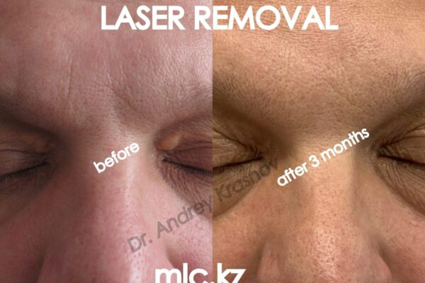 cs-removal-1-2048x1448