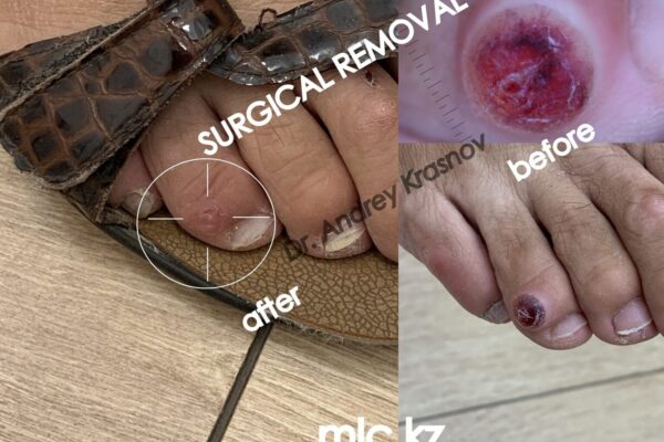 cyst-removal-3-1-2048x1448