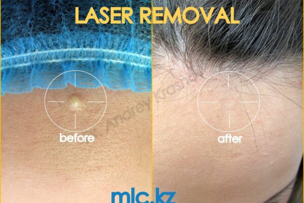 cyst-removal-5-1-2048x1448