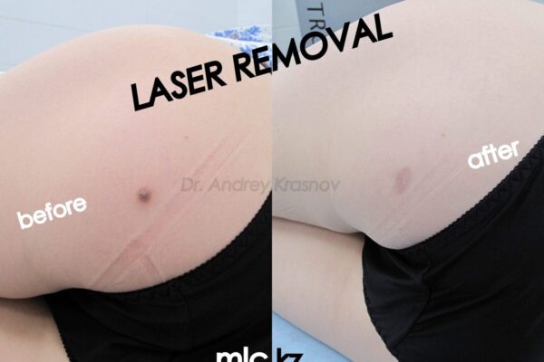 dermatofibroma-2048x1448