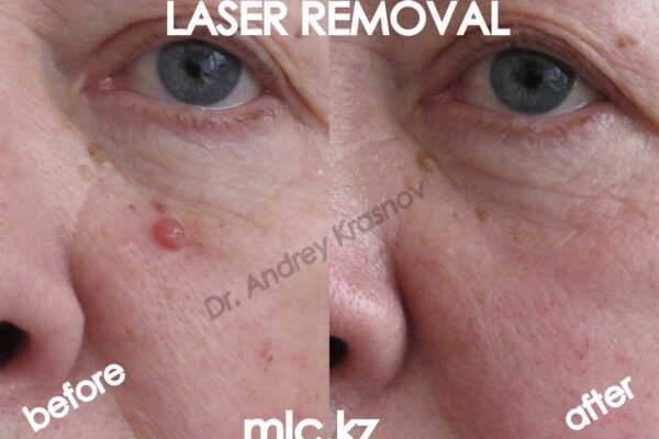 dysplastic-keratoma-1-2048x1448