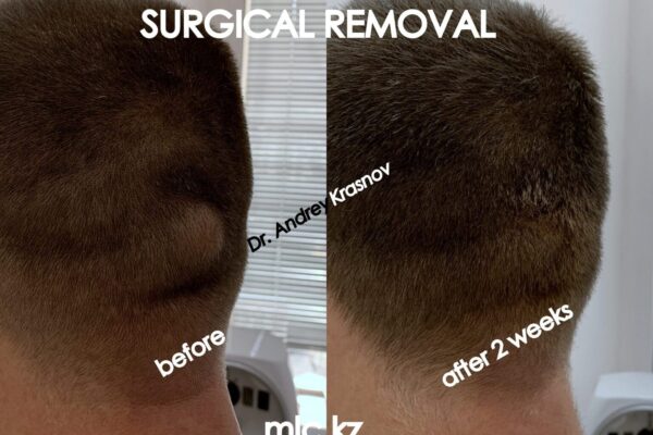 epidermal-cyst-000009-1-2048x1448