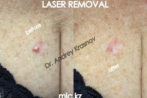 epidermal-cyst-00009-2048x1448