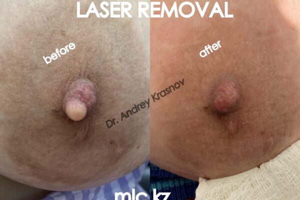 epidermal-cyst-0009-1-2048x1448