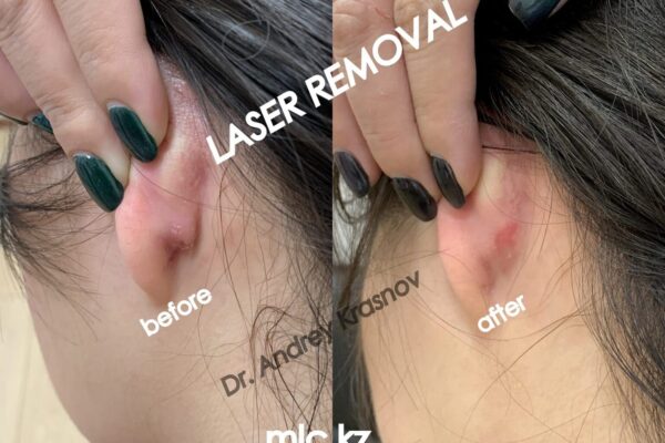 epidermal-cyst-0092-2048x1448