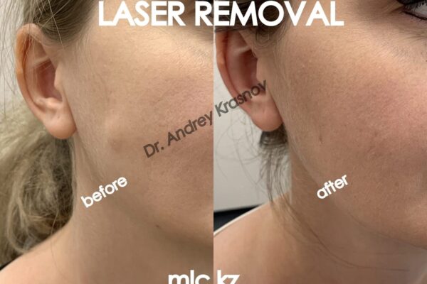 epidermal-cyst-09-1-2048x1448