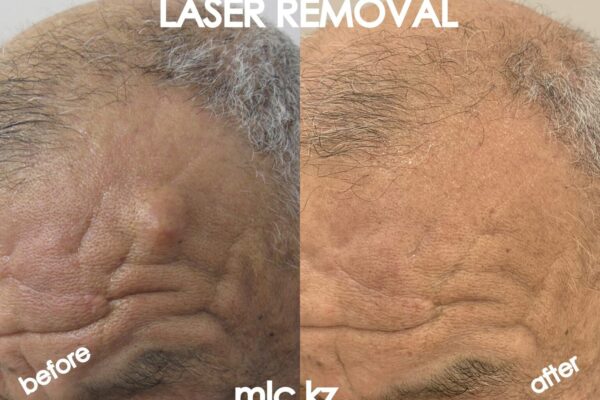 epidermal-cyst-09.11-1-2048x1448