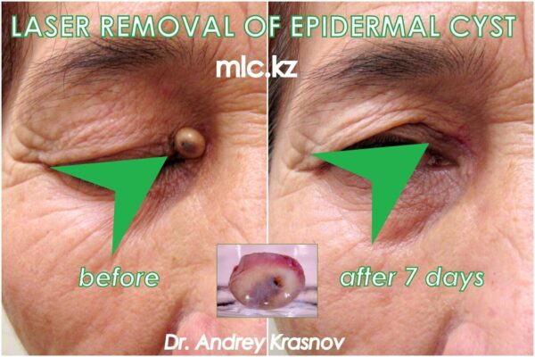 epidermal-cyst-3-2048x1365