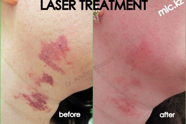 hemangioma-1-2048x1448