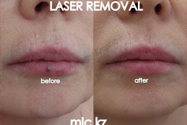 hemangioma-2-1-2048x1448