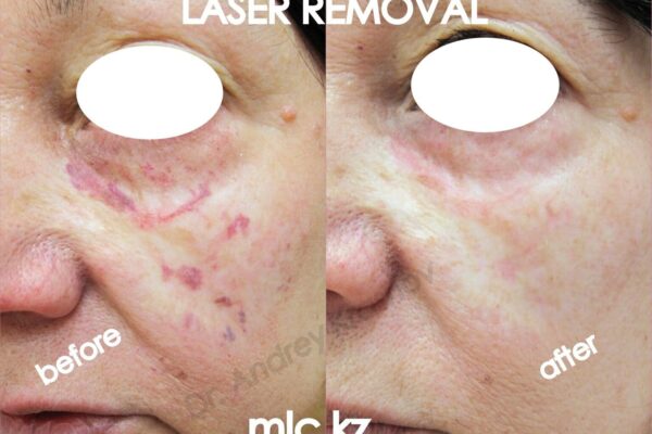 hemangioma-2-2-2048x1448