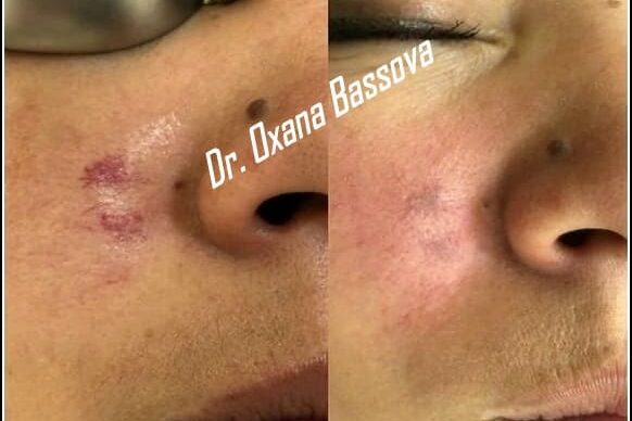 hemangioma-o.bassova-3