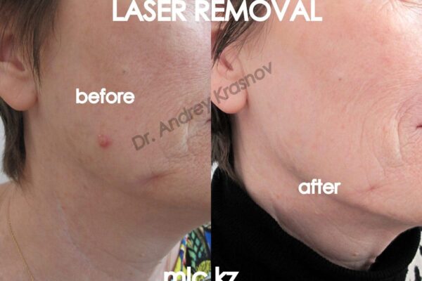 keratoacanthoma-2048x1448