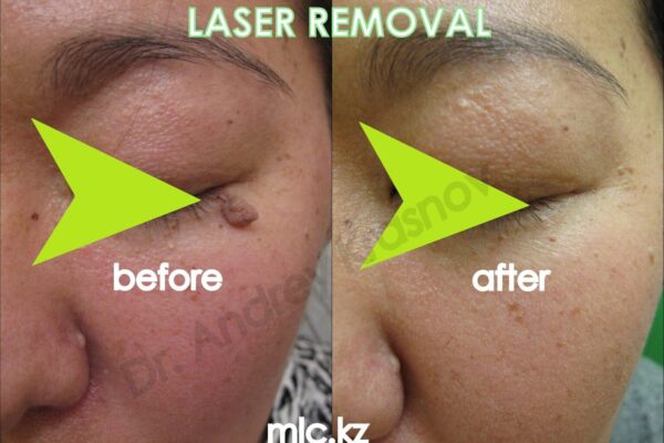 l-r-papilloma-2-2048x1448