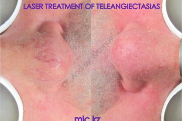 l-t-teleangiectasias-2048x1448