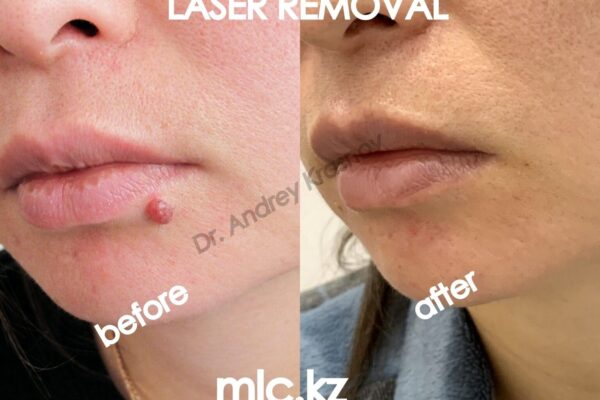 laser-removal-0309-1-2048x1448