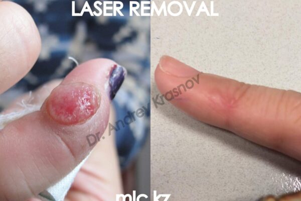 laser-removal-1-2048x1448