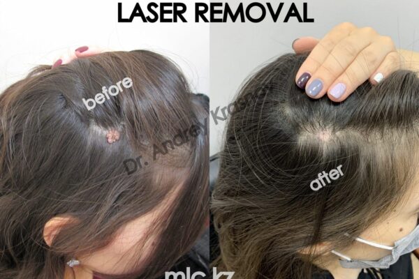 laser-removal-13.10-2048x1448