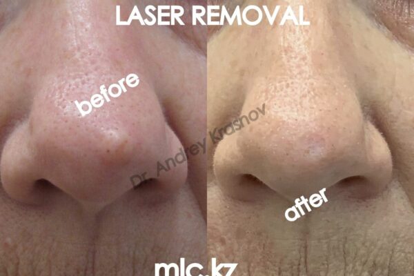 laser-removal-2-18.09.2020-1-2048x1448