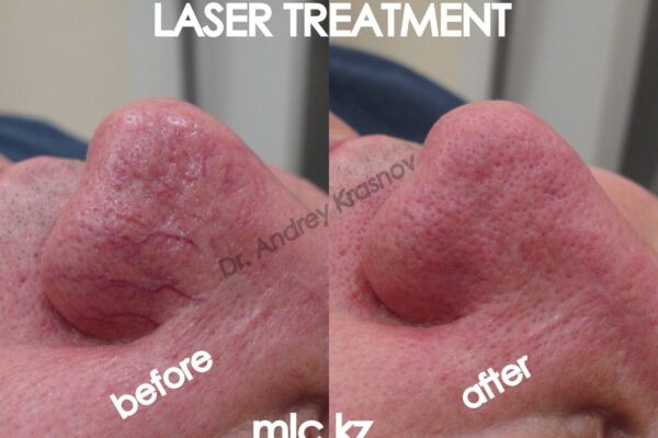 laser-treatment-1-2048x1448