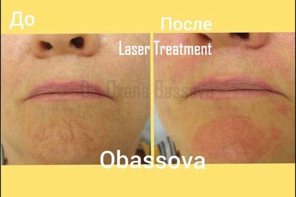 laser-treatment