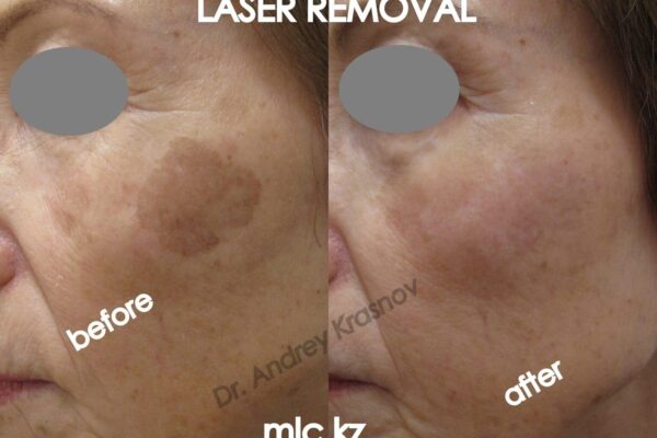 lentigo-removal-2-2048x1448