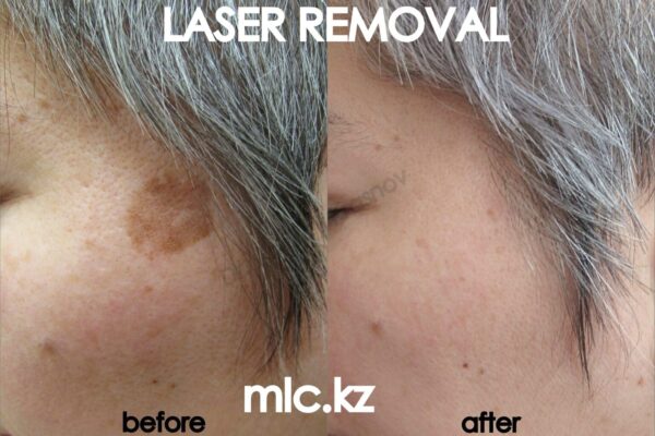 lentigo-removal-2048x1448