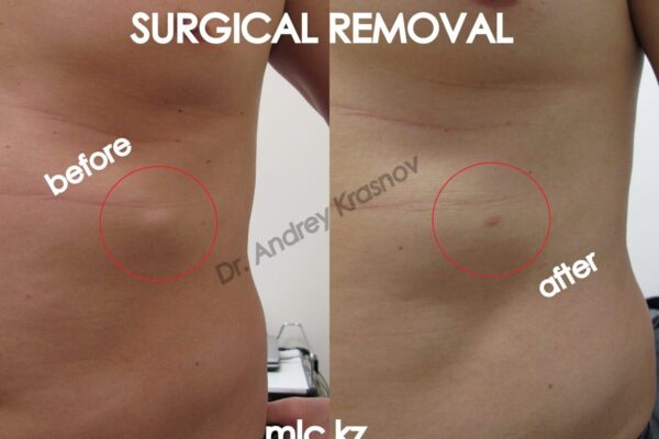 lipoma-1-26.12-kopiya-2048x1448