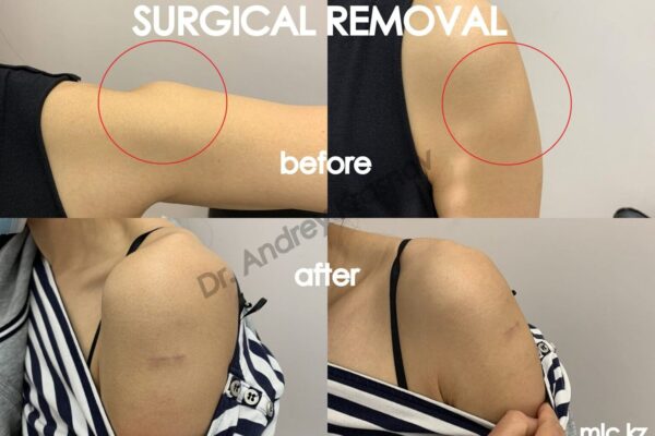 lipoma-26.12-1-2048x1448