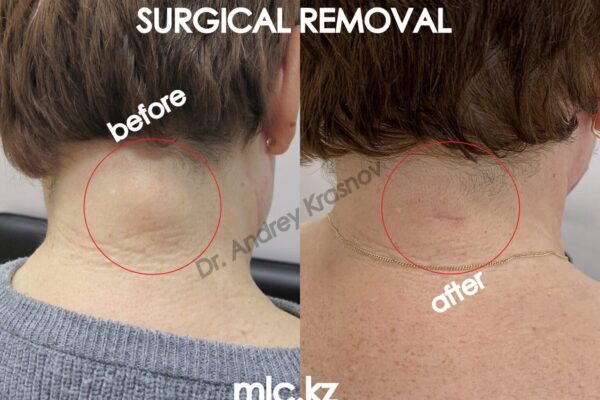 lipoma-26.12-7-2048x1448