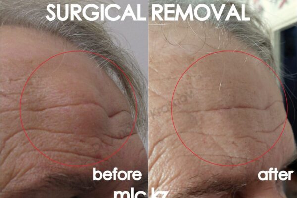 lipoma-5-1-2048x1448