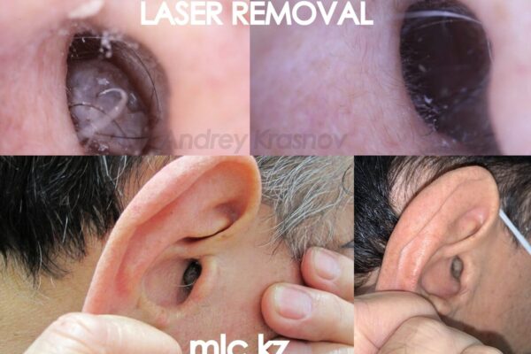 nevus-removal-3-2-2048x1448
