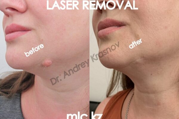 nevus-removal-4-1-2048x1448