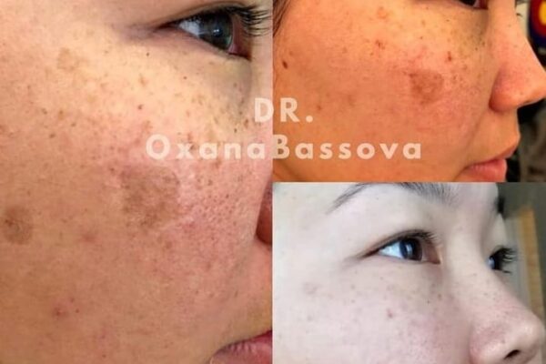 pigmentation-o.bassova