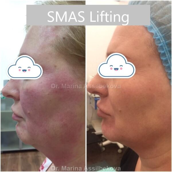 smas-lifting-assilbekova